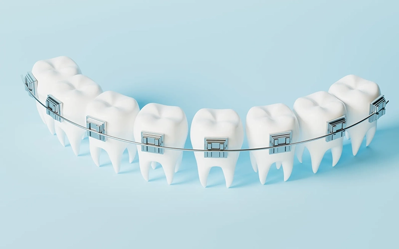 Traditional braces treatment