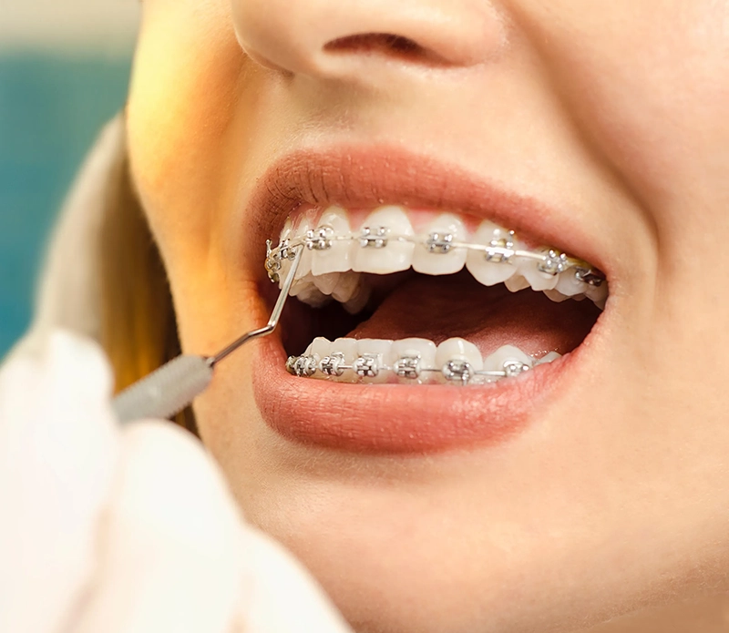 Why patients choose braces at our office