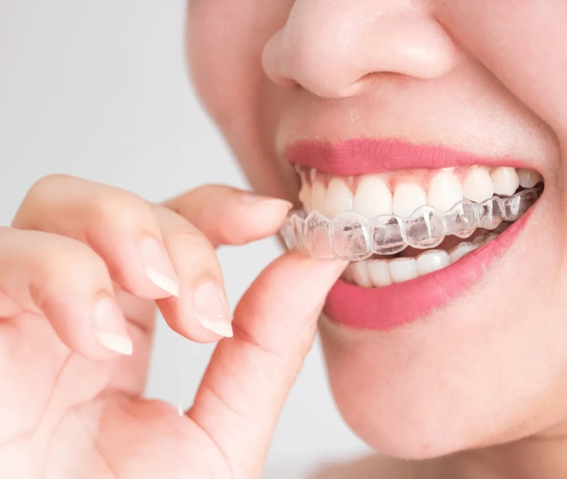 Invisalign treatment results