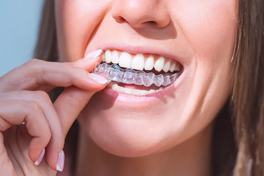Orthodontic retainers