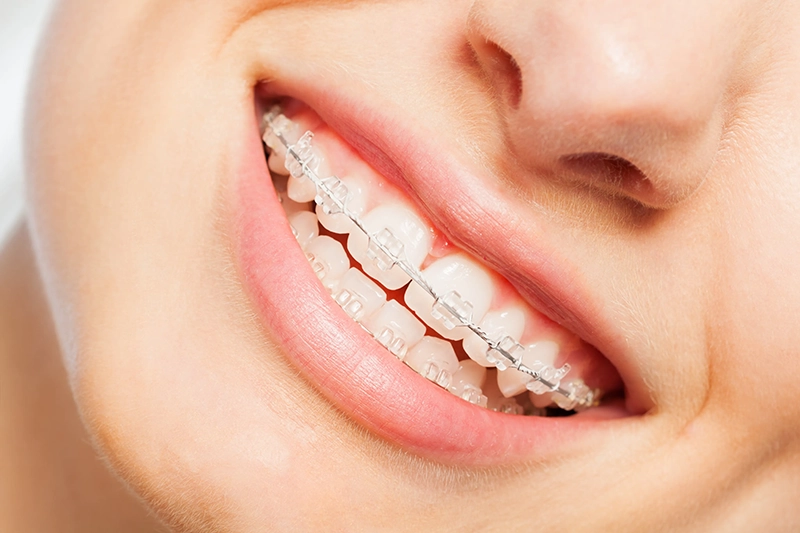 Retainer care and replacement