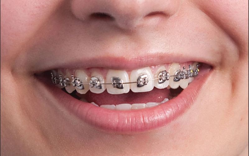 WildSmiles fun-shaped braces for kids