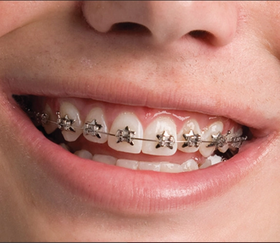 Why families choose WildSmiles braces at our office